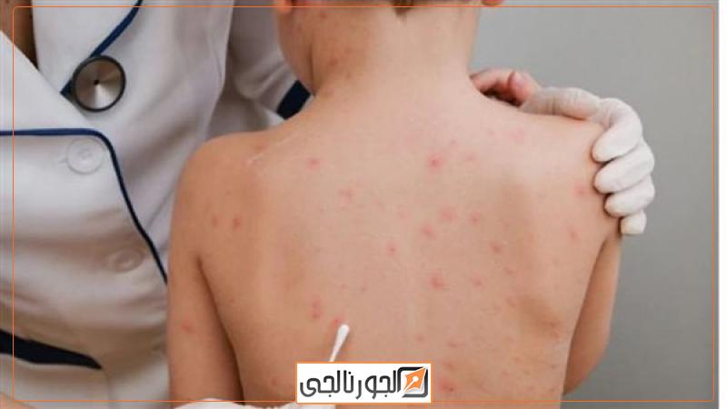 أخبار جدري القردة