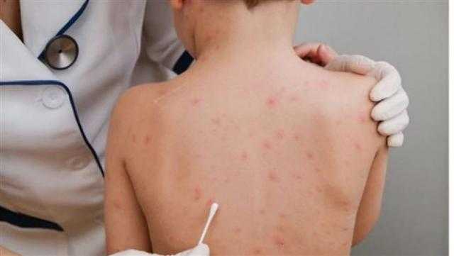البيطريين: التطعيم ضد الجدري يقي من فيروس القرود بنسبة 85%