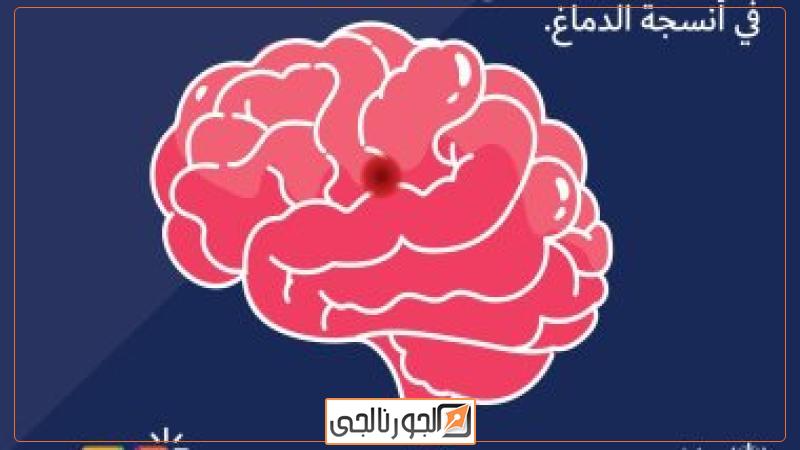السكتة الدماغية